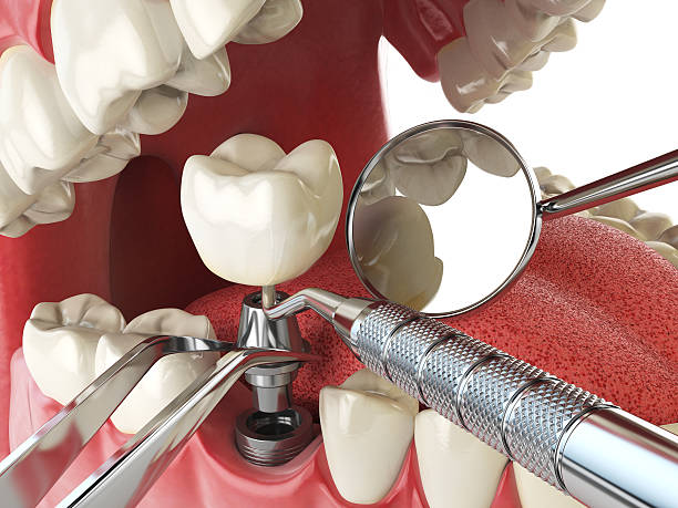 Best Emergency Dentist for Knocked-Out Tooth in Hometown, PA